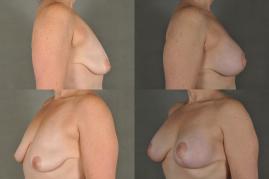 Breast Augmentation and Lift 
