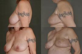 Oncoplastic Breast Reduction 
