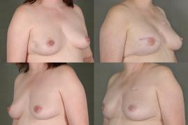 Patient in her 40s who underwent R skin sparing mastectomy and implant based reconstruction