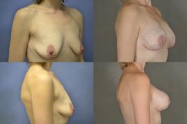 Nipple sparing implant reconstruction