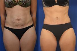 Tummy Tuck