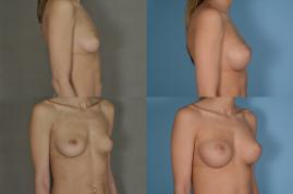 Breast Augmentation with Saline Implants, Exchange for Larger Implants