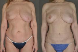 TRAM Flap Breast Reconstruction