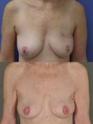 TRAM flap breast reconstruction