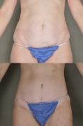 Tummy tuck and liposuction surgery