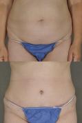 Tummy tuck