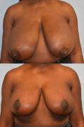 BREAST REDUCTION