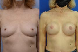 Breast Reconstruction with expanders and implants