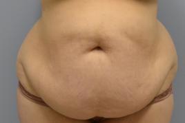 Abdominoplasty