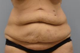 Abdominoplasty 