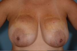 Breast Lift and Removal of Implants 