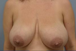 Breast Reduction