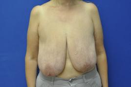 Breast Reduction