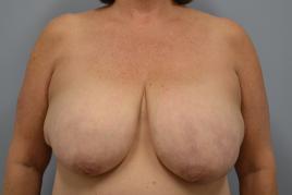 Oncoplastic Breast Reduction 