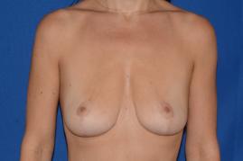 Bilateral Breast Lift