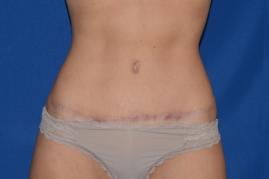 Tummy tuck and liposuction