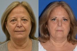 Upper and lower eyelid lift