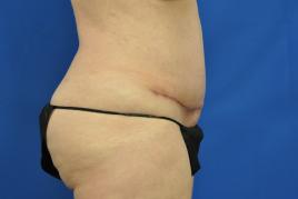 Tummy tuck and liposuction