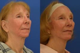 Facelift, upper lip lift and chin augmentation