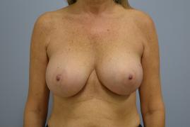  Breast Reconstruction Oncoplastic Reduction and balancing augmentation