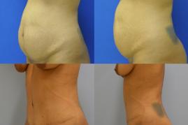 Abdominoplasty with Lipo 360 JJ1