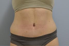 Abdominoplasty and 360 liposuction