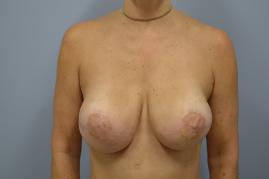 Bilateral Breast Reconstruction
