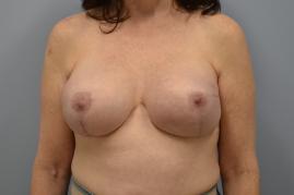 Bilateral Breast Reconstruction