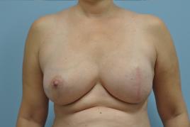 Left Breast Reconstruction