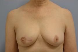 Right Breast Reconstruction