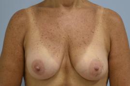 Right Breast Reconstruction and Left breast Augmentation