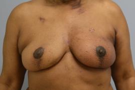 Bilateral Implant Removal and Capsulectomy 