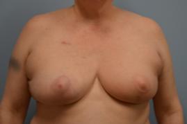 Left Oncoplastic Breast Reduction and Right Breast Reduction for Symmetry