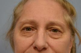 Lower face/neck lift