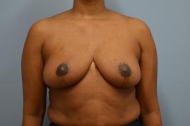 Bilateral Breast Reduction