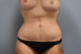 Abdominoplasty