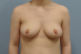 Bilateral Breast Reduction