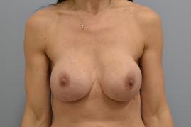Bilateral Breast Reconstruction