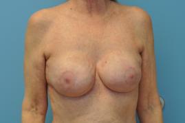 Bilateral Breast Reconstruction