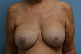 Bilateral Breast Reconstruction