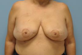 Bilateral Breast Reconstruction