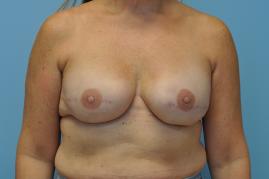 Bilateral Breast Reconstruction