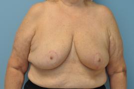 Oncoplastic Reduction