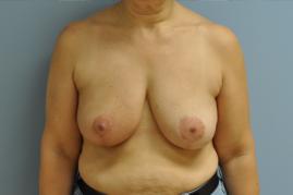 Oncoplastic Reduction