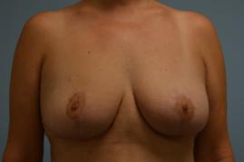 Bilateral Breast Reduction