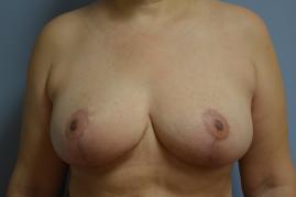 Bilateral Breast Reduction