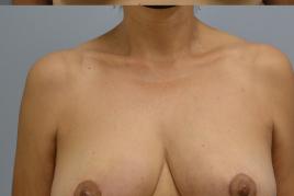 Bilateral Breast Reduction