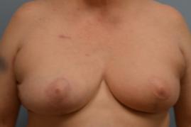 Oncoplastic Reduction