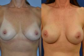 Breast Augmentation S304