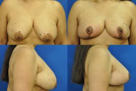 Breast Lift S305